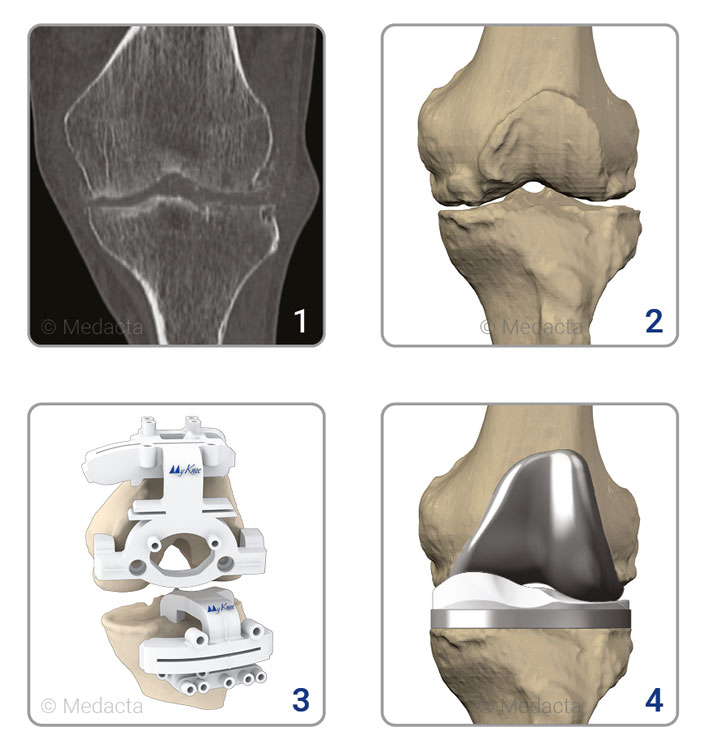 Verfahren der Kniegelenk Implantation MyKnee in 4 Schritten