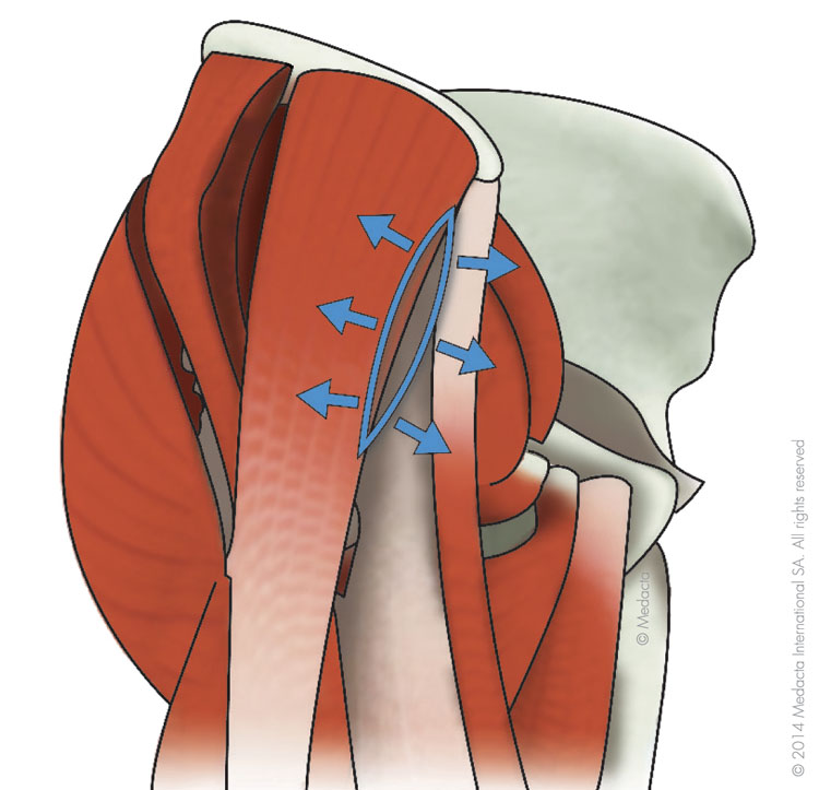 Anatomie einer Hüfte mit Muskeln und Knochen zur Darstellung der AMIS Methode